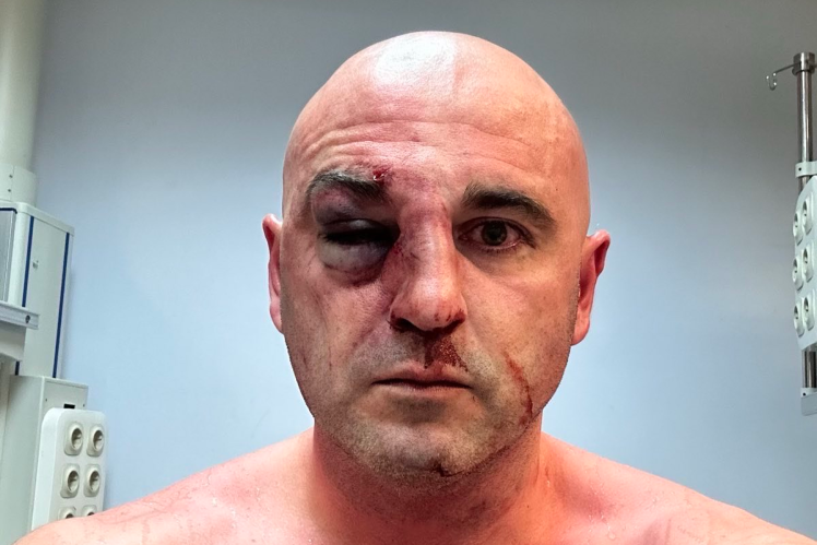 Леван Хабеішвілі після мітингу, на якому поліцейські зламали йому ніс.