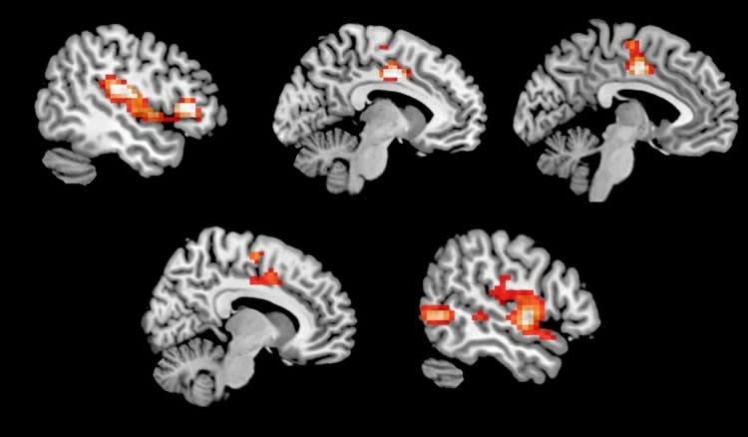 Ділянки мозку, які під час експерименту проявили підвищену активність під впливом MDMA.